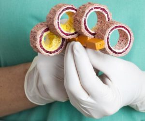 Сужение сосудов нижних конечностей лечение