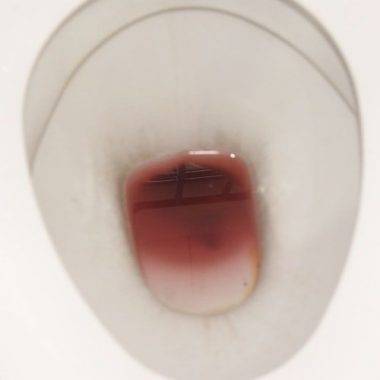 Кровотечения при геморрое что делать