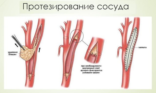 Болезнь лериша