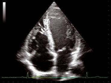 Расчет конечного систолического объема левого желудочка