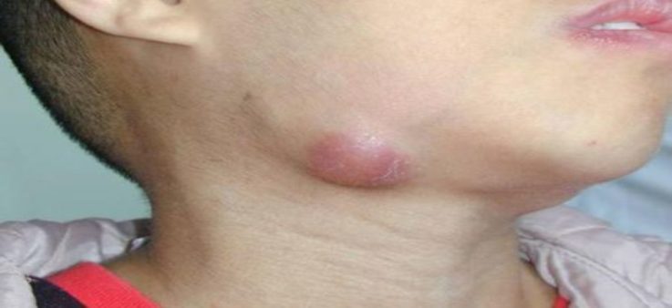 Неспецифический лимфаденит лечение