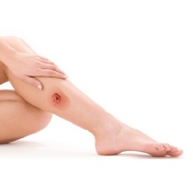 Болячка на ноге не заживает и чешется