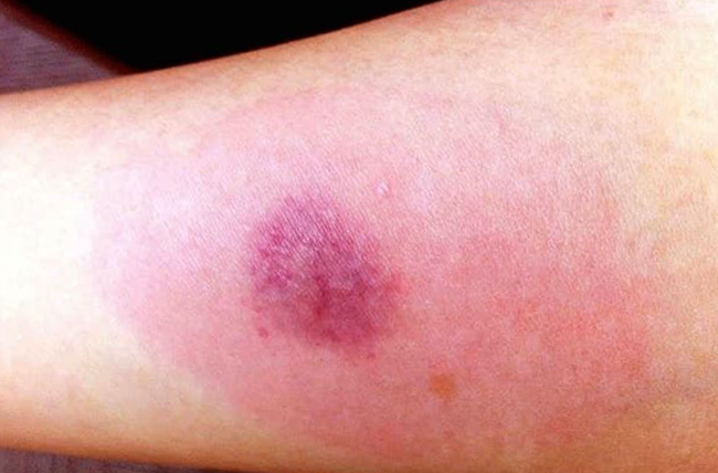 Диаскинтест