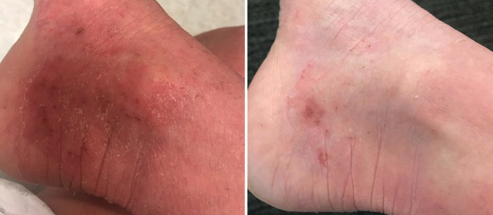 До и после применения крема с мочевиной