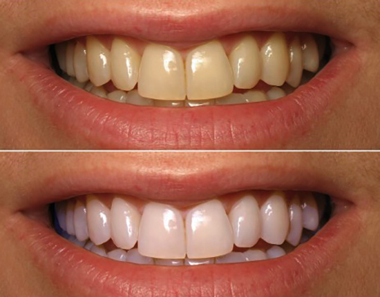 До и после соды