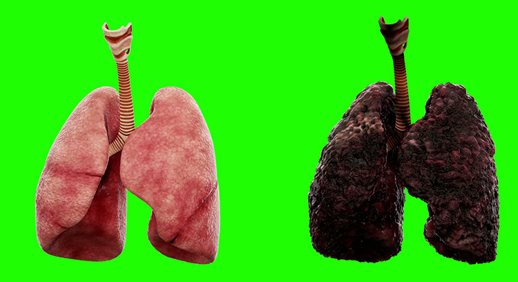 Легкие здорового и курильщика