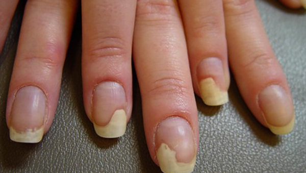 Онихолизиз