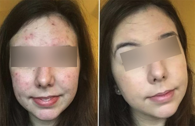 Лицо до и после березового дегтя