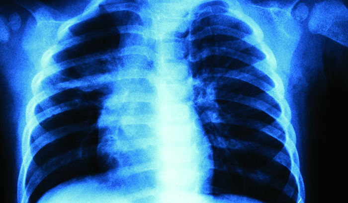 Рентгеновский снимок легких