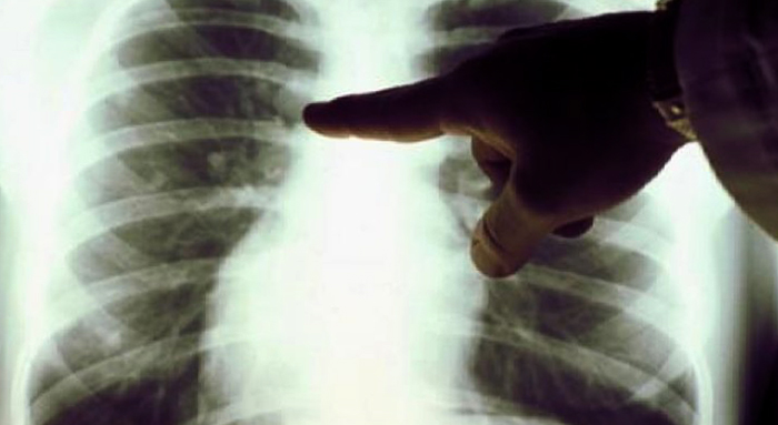 Рентген легких