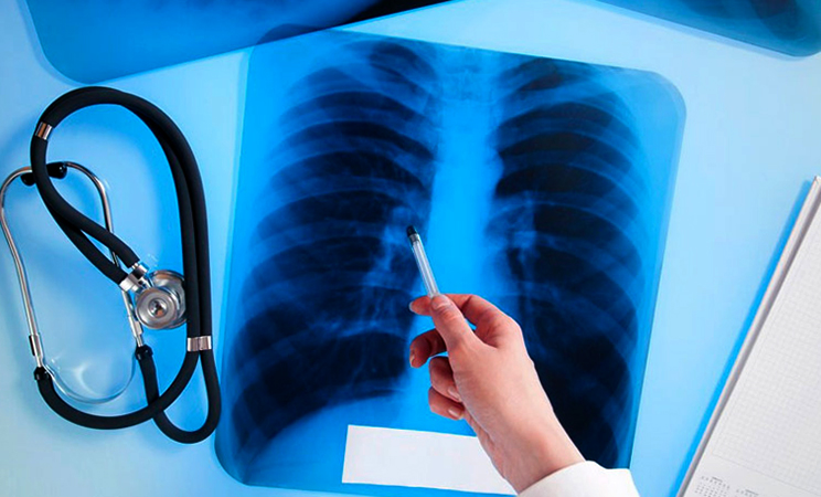 Снимок легких