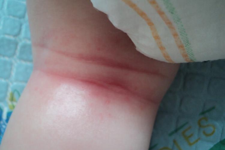 Аллергическая реакция