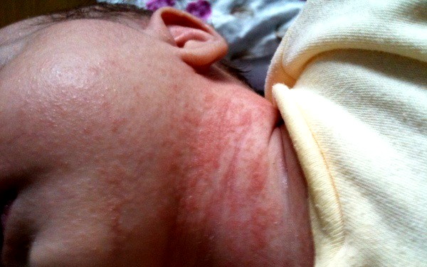 опрелость у малыша