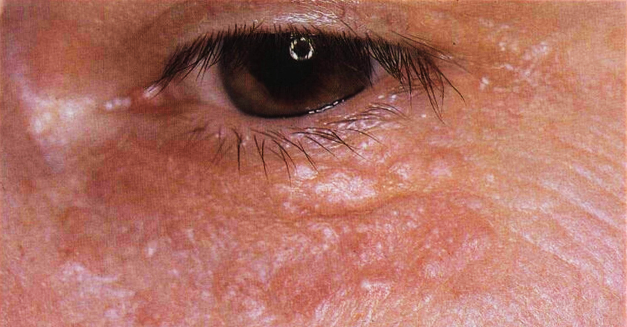 аденнома сальных желез