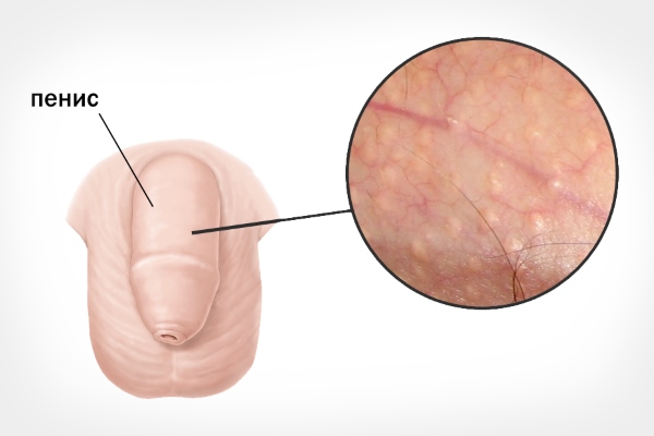 сыпь на пенисе