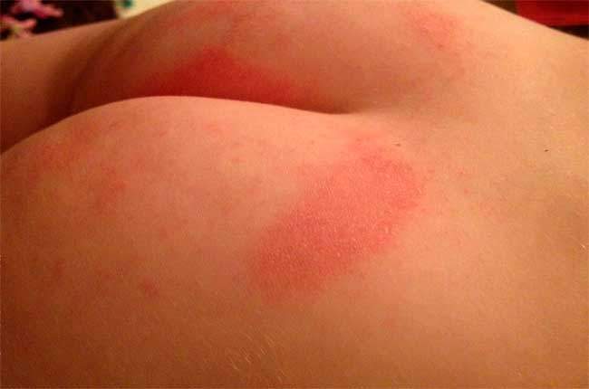 опрелость у ребенка