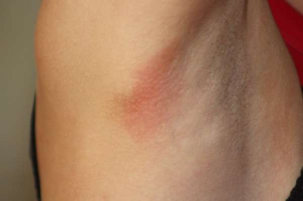 покраснение под мышками