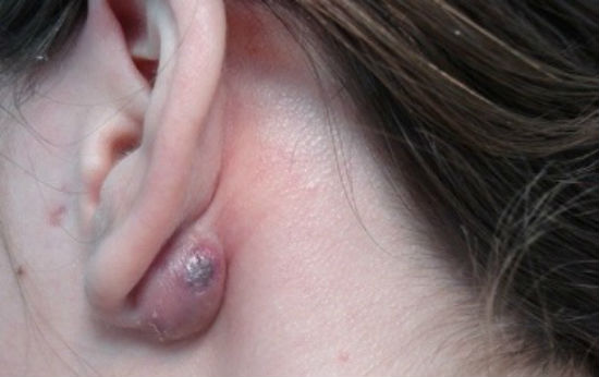 атерома за ухом