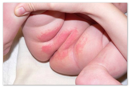 опрелость у ребенка