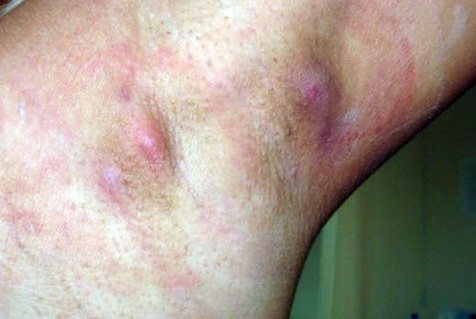 раздражение подмышек