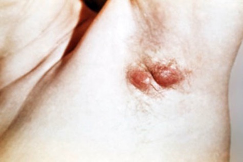 гидраденит