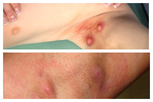 виды гидраденита