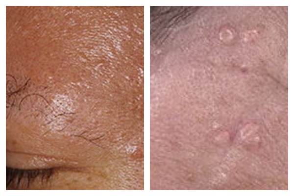 внешний вид гиперплазии