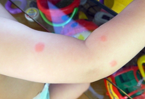 красные пятна на руке