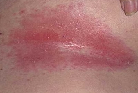 грибковая опрелость на коже