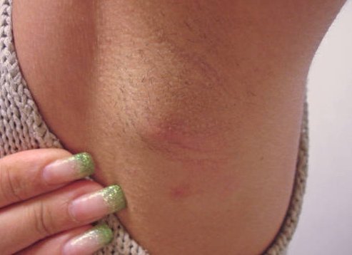 Увеличение железы под мышкой