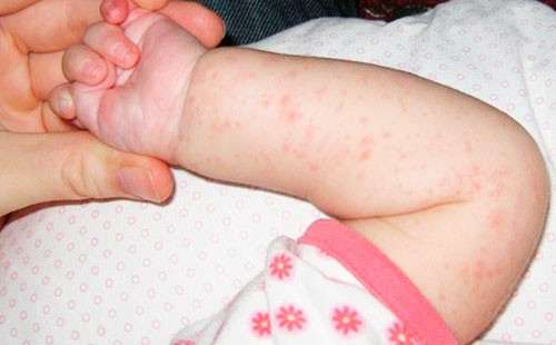 потница на ручке