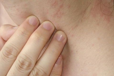 потница на шее