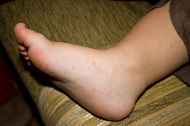 потничная сыпь на ногах